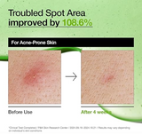 Anua Azelaic Acid 10 Hyaluron Redness Soothing Serum, Facial Serum for Sensitive skin, Hyaluronic Acid, Niacinamide