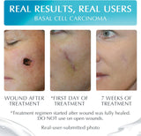 NewGel+E Advanced Silicone Gel for Scars - 15 Grams