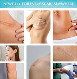 NewGel+E Advanced Silicone Gel for Scars - 15 Grams